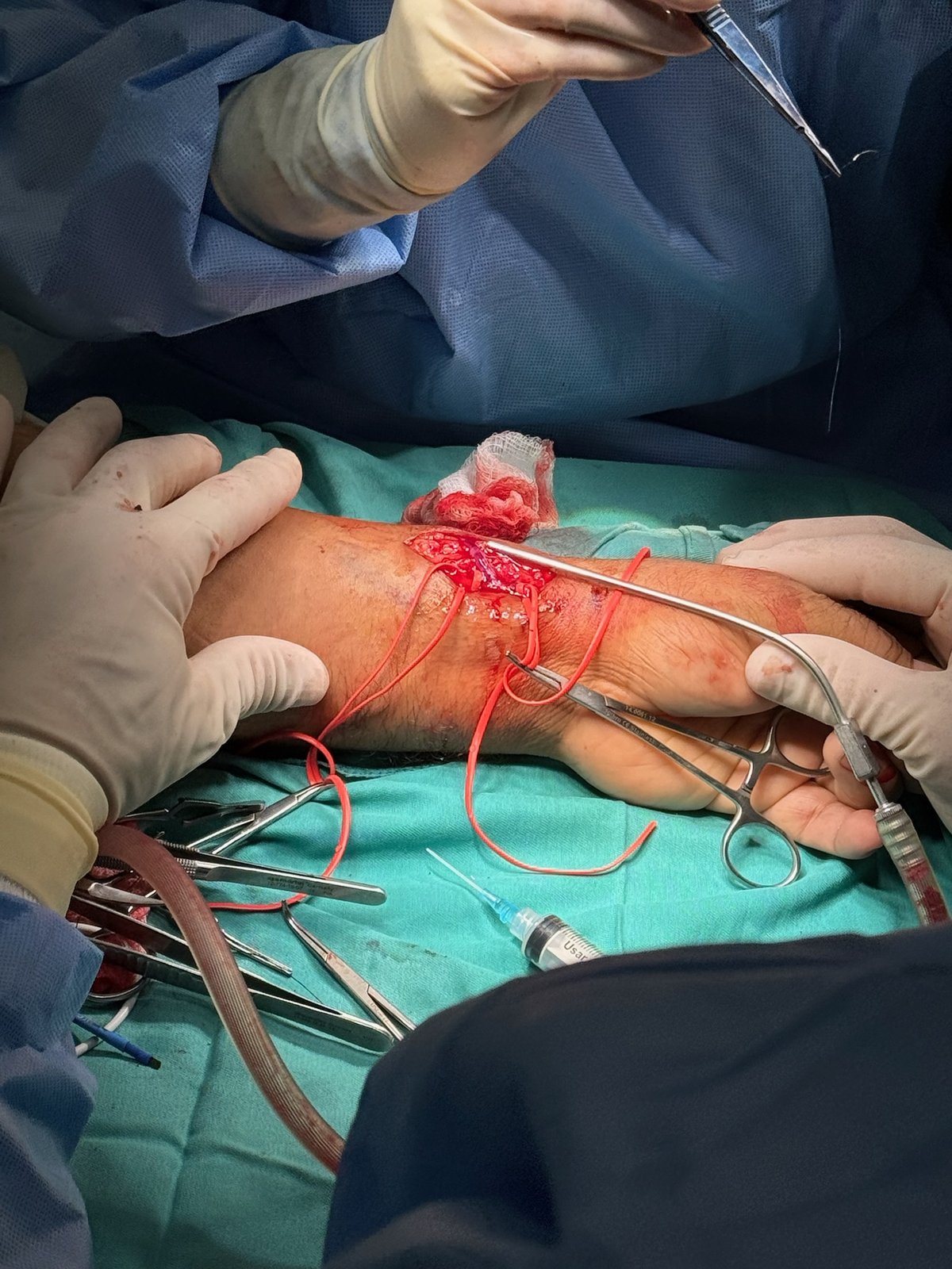 Close view of an AV fistula wrist field with red vessel loops and gloved hands